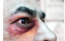 Bệnh nấm đen ở những bệnh nhân COVID-19