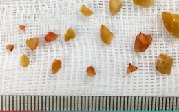 Hóc hạt lạc khiến 3 trẻ suy hô hấp nặng do bít tắc đường thở