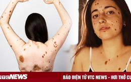 Cô gái sở hữu 1.200 nốt ruồi khắp cơ thể phá vỡ tiêu chuẩn 'đẹp không tỳ vết'
