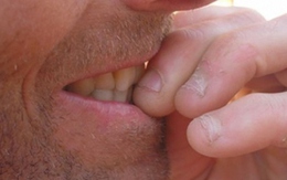 Tác hại khôn lường của việc cắn móng tay