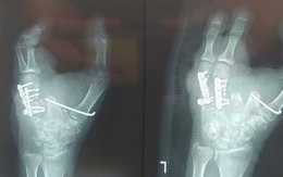 Lắp ngón chân thành ngón tay cho bệnh nhân