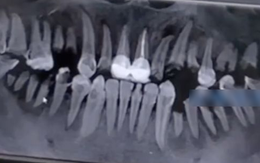 Chàng trai 23 tuổi răng bị ăn mòn, gãy gần hết cả hàm vì loại đồ uống giới trẻ không ai là không thích