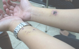 Người đi tiêm vắc-xin phòng bệnh dại tăng chóng mặt