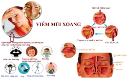 Các thói quen xấu dễ dẫn đến viêm mũi xoang