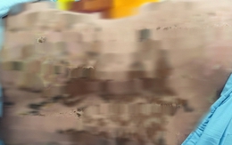 Suýt mất mạng vì dùng thuốc nam không rõ nguồn gốc chữa đau khớp