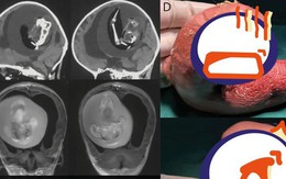 Mang thai đôi nhưng chỉ sinh một bé, 1 năm sau bố mẹ đưa con gái đi khám mới phát hiện sự thật đáng sợ nằm trong não