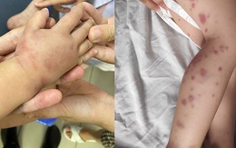 Trẻ 41 tháng tuổi phù nề, bầm tím tay chân vì nguyên nhân không ngờ