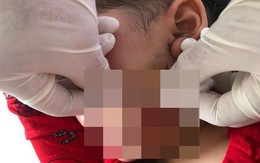 Bé trai 3 tuổi ở Cà Mau bị chó dại cắn đứt nửa bên lưỡi