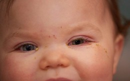 Triệu chứng mới của COVID-19 xuất hiện ở mắt