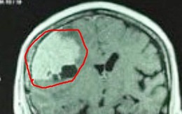 Đau đầu kéo dài vì khối u màng não 'khổng lồ'