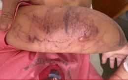Bị sứa đốt khi tắm biển, bé 7 tuổi nhập viện trong tình trạng mất ý thức