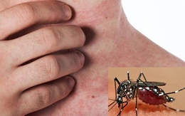 4 vấn đề sức khỏe bạn có thể gặp sau khi khỏi sốt xuất huyết