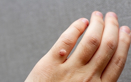 Mụn cóc có 'nhảy' từ người này sang người khác và gây nguy hiểm hay không?