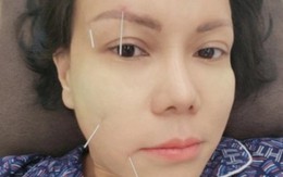 Vài sao Việt không may bị liệt nửa mặt, có người đứng trước nguy cơ đột quỵ