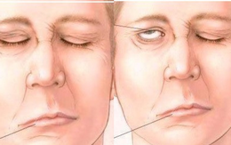 Trúng gió và đột quỵ não thường bị nhầm lẫn, phân biệt ra sao để có cách xử trí đúng?