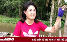 Sau 23 lần phẫu thuật, người phụ nữ từng bị chồng đổ xăng đốt hiện ra sao?