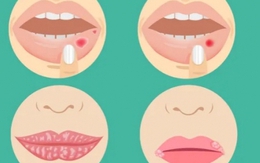 4 dấu hiệu bệnh nghiêm trọng có thể xuất hiện ở môi: Nếu thấy cần đi khám ngay