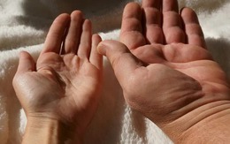 Acromegaly: Một căn bệnh hiếm gặp, khiến người lớn phát triển không kiểm soát được