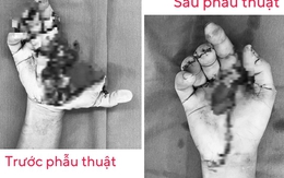 Một bệnh viện tiếp nhận 15 ca tai nạn do pháo nổ trong ngày