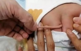 Bé sơ sinh ở Trung Quốc có đuôi dài 10cm mọc ra từ lưng