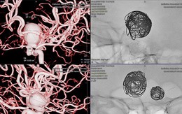 Các bác sĩ xin tiền cứu bệnh nhân nghèo có 3 'quả bom nổ chậm' trong đầu