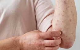 Ghi nhận 78 ca nghi mắc sởi và rubella, Bộ Y tế chỉ đạo nóng