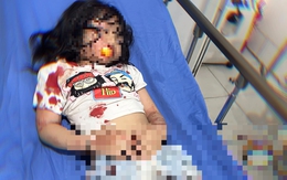 Bé 5 tuổi ở Hà Giang bị chó cắn trọng thương: Người mẹ bủn rủn khi thấy con bê bết máu