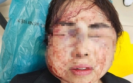 Người phụ nữ bị chồng bạo hành trước ngày ly hôn: Chồng tôi mắc “bệnh” cuồng ghen