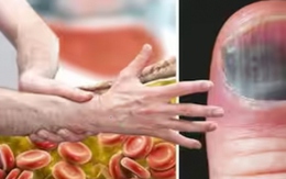 7 dấu hiệu bất thường báo hiệu cholesterol cao ở nam giới phát ra ở bàn tay