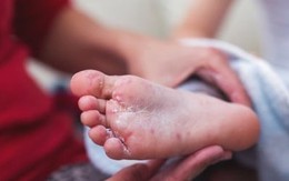 Số ca mắc tay chân miệng ở Hà Nội tăng, phát hiện thêm ổ dịch mới