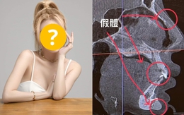 Sốc: Sao nữ nghiện “dao kéo” tung ảnh chụp X-quang khuôn mặt với dị vật 3cm tồn tại trong cằm suốt 8 năm