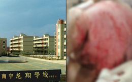 Nam sinh Trung Quốc nghi bị bạn dội nước sôi vào người: Cảnh sát tạm giữ 8 người