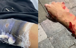 Xem Euro về muộn, một thanh niên ở Hà Nội bị chém và cướp xe máy trước cửa Nhà hát lớn