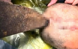 Nam sinh bị lưỡi dao cắm sâu vào sọ não