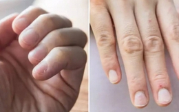 Bàn tay lạnh có thể là dấu hiệu cảnh báo của tình trạng sức khỏe được coi là "kẻ giết người thầm lặng"