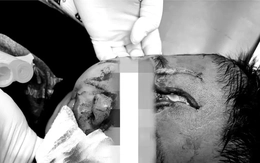 Bé trai 5 tuổi bị chó béc giê nhà hàng xóm cắn nát mặt