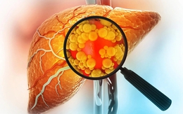 Tiêu thụ quá nhiều 2 đồ uống này, đừng trách vì sao gan ngập trong mỡ: Nghiên cứu mới đưa ra bằng chứng