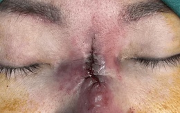 Người phụ nữ bị “ăn thủng mũi” sau khi làm đẹp đổi vận