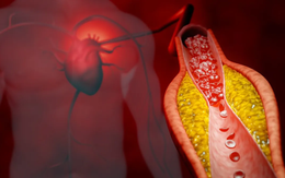 8 món ăn nhiều người mê âm thầm “phá hỏng” mạch máu: Bác sĩ nói thẳng "có cho tiền cũng không ăn"