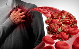 Hàng trăm cục máu đông bít tắc động mạch: "Thủ phạm" là 1 thói quen thường gặp ở người Việt