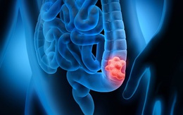 Cảnh báo: Yếu tố này khiến một người gần như chắc chắn mắc ung thư đại tràng nếu không được phát hiện