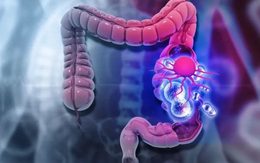 Bác sĩ Bệnh viện K điểm danh 4 thói quen là “mồi nuôi” ung thư đại trực tràng