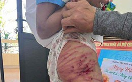 Vụ bé gái lớp 5 bị bạo hành ở Hà Tĩnh: Công an triệu tập cha dượng