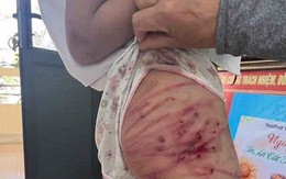 Vụ bé gái lớp 5 ở Hà Tĩnh bị bạo hành: Công an làm việc với người cha dượng