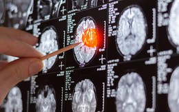 Sốc khi phát hiện 11 khối u trong não