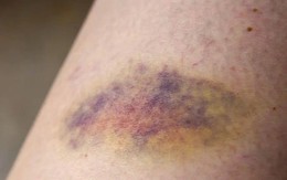 1 dấu hiệu trên da có thể cảnh báo ung thư "cận kề": Bác sĩ khuyên nếu thấy nên đi khám ngay