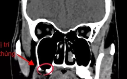 Nhổ 'răng khôn', người đàn ông bị đục thủng xoang hàm