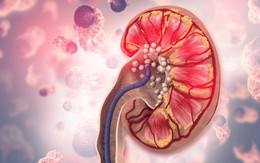 Người có axit uric máu cao thường có 3 đặc điểm này khi ăn uống: Có 1 cũng khiến thận sớm suy hỏng