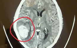 Phát hiện dấu hiệu lạ ở mặt khi đi chợ sớm, bệnh nhân làm ngay 1 việc khiến bác sĩ khen “quá sáng suốt”