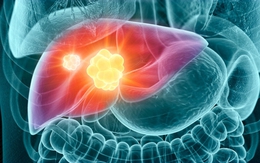 Những triệu chứng sớm nhất của ung thư gan - biết rõ sẽ "cứu mạng"